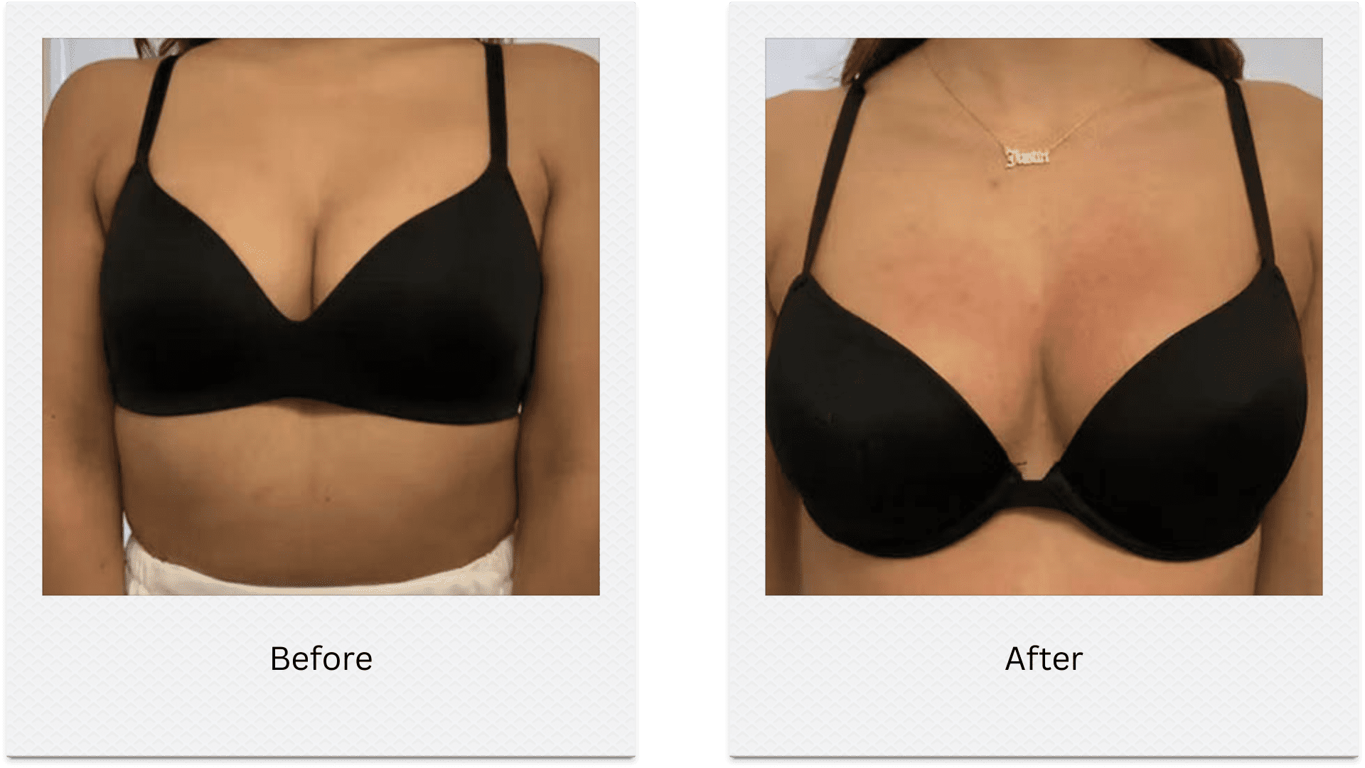 Non-Surgical Breast Lift | Lift and Firm Without Surgery